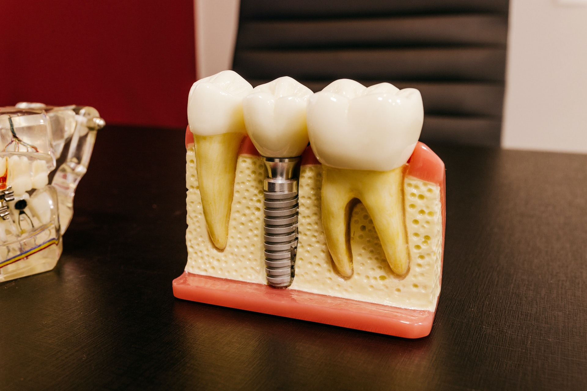 Zubni implanti
